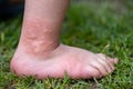 Close-up of a child's leg with stinging nettle blisters