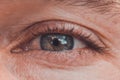 Close-up, clearly expressed conjunctivitis and redness on the eye Royalty Free Stock Photo