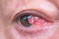 Close up of the conjunctiva squamous cell carcinoma. Royalty Free Stock Photo