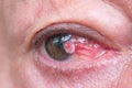 Close up of the conjunctiva squamous cell carcinoma.