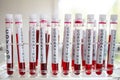 Close-Up on 19 Vaccine on Laboratory Tube