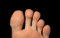 Close up of cracked foot fingers of human skin isolated on back background in medical healthcare treatment concept