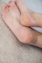 Close up cracked heels. Health problems with skin on feet Royalty Free Stock Photo
