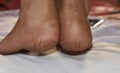 Close up of Cracks on Heels isolated white background. Dehydrated skin on the heels of female feet