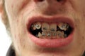 Close up of crooked teeth with braces Royalty Free Stock Photo