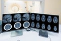 Close up CT-scan control room and showing brain image meningioma in brain CT scan room background, Medical healthcare.