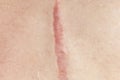 Close up of cyanotic keloid scar caused by surgery and suturing, skin imperfections or defects. Hypertrophic Scar on skin,