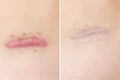 Close up of cyanotic keloid scar caused by surgery and suturing, skin imperfections or defects before and after treatment and