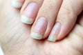 Close up of damaged nails that have problem after doing manicure. Health and beauty problem