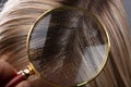 Dandruff In Hair Seen Through Magnifying Glass Royalty Free Stock Photo