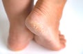 Close up Dehydrate skin dry foot cracks skin rough skin Royalty Free Stock Photo