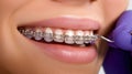 Close-Up of Dental Braces Adjustment Royalty Free Stock Photo