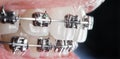 Close-up dental braces on teeth. Orthodontic Treatment Royalty Free Stock Photo