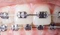 Close-up dental braces on teeth. Orthodontic Treatment