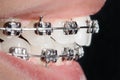 Close-up dental braces on teeth. Orthodontic Treatment Royalty Free Stock Photo