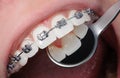 Close-up dental braces on teeth. Orthodontic Treatment Royalty Free Stock Photo