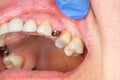 Close-up dental implant wort patient in a dental clinic during treatment. The concept of surgical aesthetic dentistry Royalty Free Stock Photo