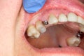 Close-up dental implant wort patient in a dental clinic during treatment. The concept of surgical aesthetic dentistry Royalty Free Stock Photo