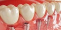 Close up of dental teeth implant. Royalty Free Stock Photo