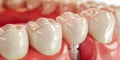 Close up of dental teeth implant. Royalty Free Stock Photo