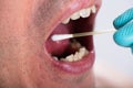 Dentist Making Saliva Test On The Mouth With Cotton Swab