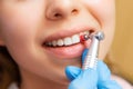 Close-up dentist performing teeth grinding procedures in clinic