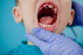 Close up of dentist`s hands with assistant in blue gloves are treating teeth to a child, patient`s face is closed Royalty Free Stock Photo