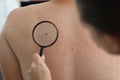 Dermatologist doctor examines birthmark of patient on back with magnifying glass