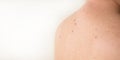 Close up detail of the bare skin on a man back with scattered moles and freckles. Royalty Free Stock Photo