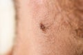 Close up detail of the bare skin on a man back with scattered moles and freckles. Royalty Free Stock Photo