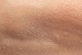 Close up detail of flaky human epidermis Royalty Free Stock Photo