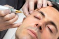 Close up detail of laser plasma pen removing facial melanoma on middle aged man Royalty Free Stock Photo