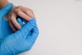 Close-up of doctor wearing blue gloves examining child hand affected by viral warts Verruca vulgaris. Papillomavirus