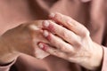 Woman hands with atopic dermatitis, eczema, allergy reaction on skin Royalty Free Stock Photo