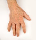 Hand Deformed From Rheumatoid Arthritis