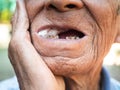 Close up of Elderly man biting on cotton gauze after tooth extraction, Tooth decay from not like brushing teeth. Oral care