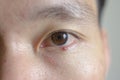 Close up eye brown with stye infection. Royalty Free Stock Photo