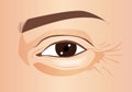 Close-up eye with crow\'s feet eyes and puffy eye bag area, illustration