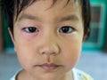 Close up face of asian child boy have swell allergic eye from insect bite Royalty Free Stock Photo