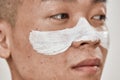 Close up of face of young asian man with problematic skin and hyperpigmentation applied mask on his face, looking away
