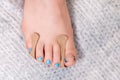 Close-up of female foot with a bracket on the nail and a silicone impression inserted between the fingers. Correction of Royalty Free Stock Photo