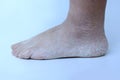 Close up of female foot, heel with dry, badly cracked skin and cracks. Dermatology, medical, cosmetic concept human feet with