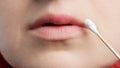 Close-up of female lips with herpes and cotton swab with ointment