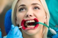 Close up of female mouth with retractor and composite use for whitening the teeth in dental office. Royalty Free Stock Photo