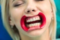 Close up of female mouth with retractor and composite use for whitening the teeth in dental office. Royalty Free Stock Photo