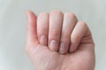 Close up female nails without manicure. Overgrown cuticle fingernails and tainted nail plate. Health and beauty problems