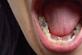 Close up of female patient mouth with decayed tooth. Dental heal
