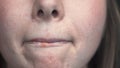 Close-up of female problem skin with herpes on lips. Media. Well-groomed skin of face with black spots and inflammation