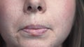 Close-up of female problem skin with herpes on lips. Media. Well-groomed skin of face with black spots and inflammation