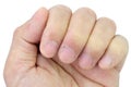 Close-up of fingers and nails with dry skin, torn and flaking off Royalty Free Stock Photo